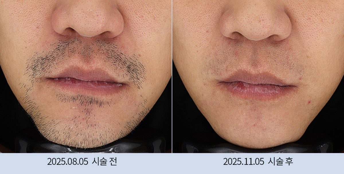 스노우의원 다산점 레이저 제모 전후